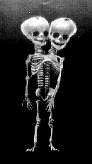 The skeleton of a type of conjoined twin known as 'Dicephalus', where both heads of the twin share one body.