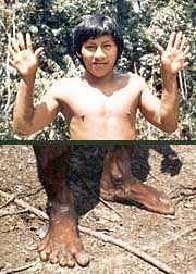 Some Waorani had six fingers and six toes